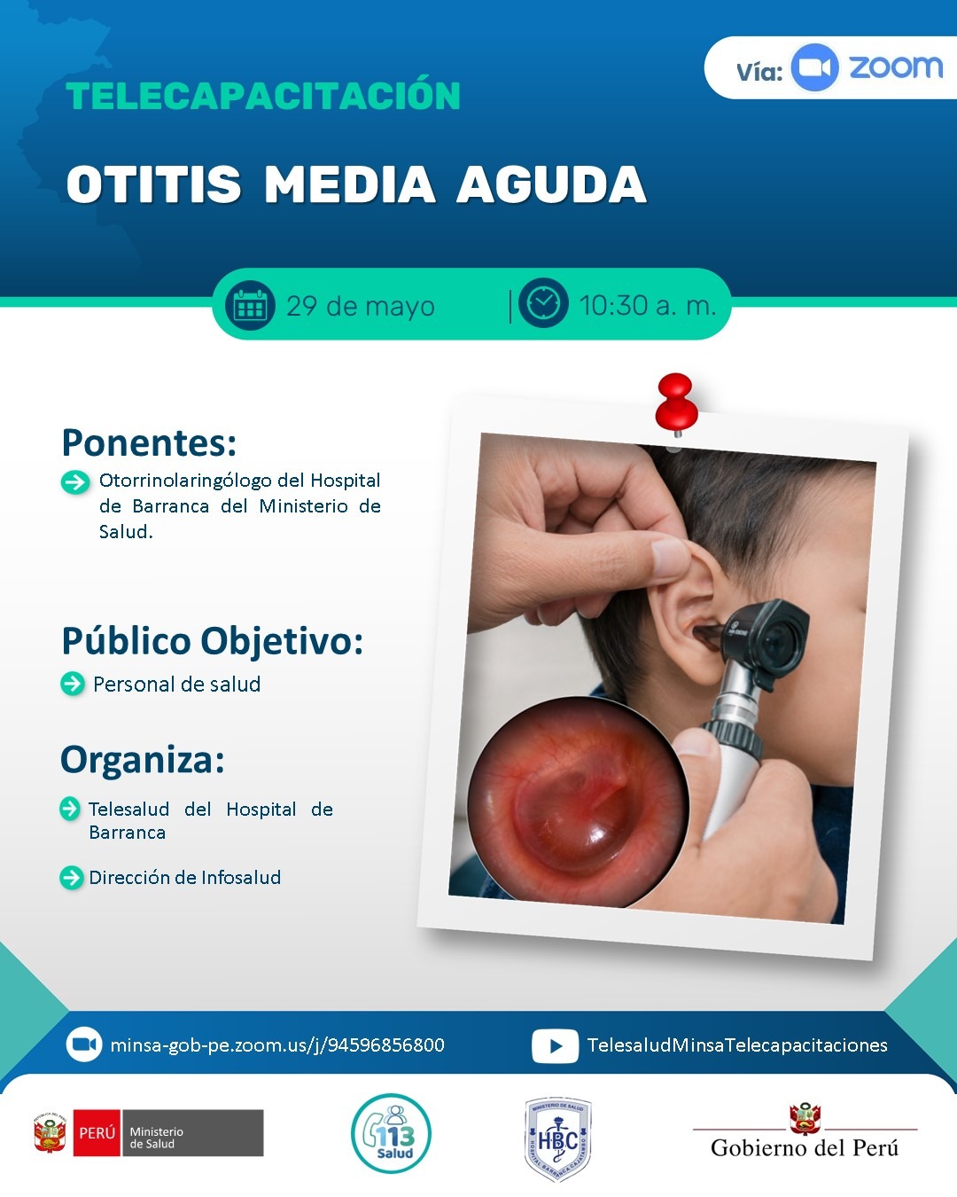 OTITIS MEDIA AGUDA